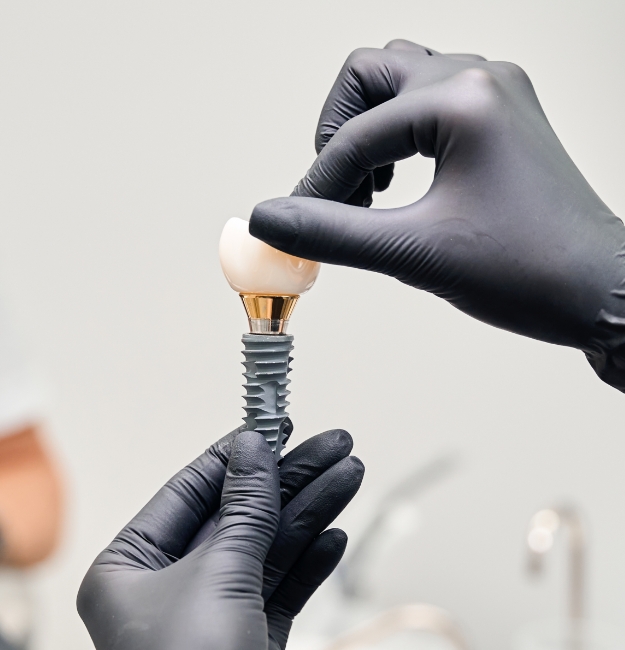 Implants dentaires Implants dentaires