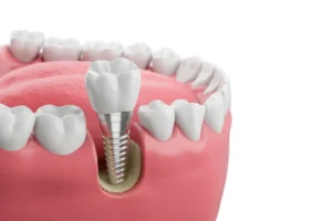 Image 3d d'un implant dentaire surmonté d'une couronne pour remplacer une dent manquante