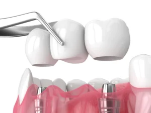 Image 3d d'un pont dentaire sur implants